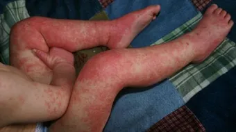 ما أسباب الطفح الجلدي عند الاطفال