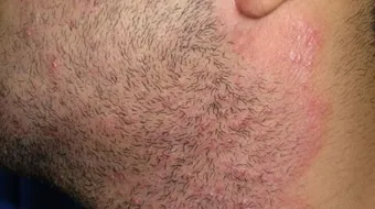 ما أسباب حساسية الجلد