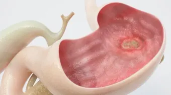 ما هي أسباب قرحة المعدة