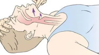 ما أسباب بلع اللسان