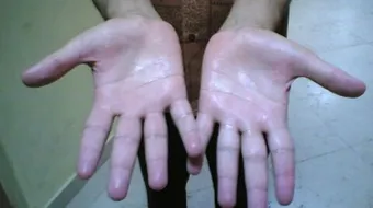 ما هي أسباب تعرق اليدين
