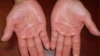 ما أسباب تعرق اليدين والقدمين