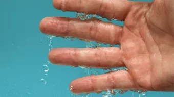 ما أسباب تعرق اليدين