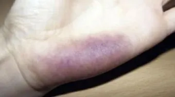 ما هي أسباب ظهور بقع زرقاء في الجسم