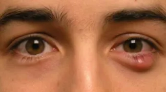 ما هي أسباب ظهور الدمامل