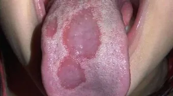 ما أسباب تقرحات اللسان