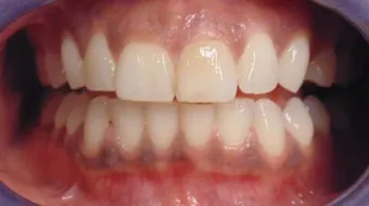 ما أسباب بياض اللثة