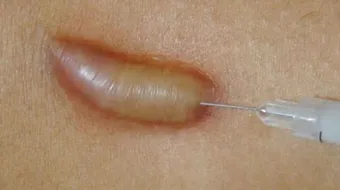 ما هي مضاعفات استخدام الكورتيزون الموضعي على الجلد