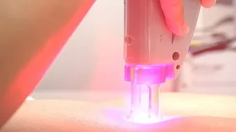 ما هي أضرار الليزر لإزالة الشعر