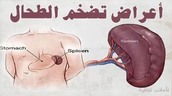 ما هي أمراض الطحال