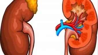 ما هي الأمراض التي تصيب الجهاز البولي