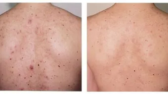 ما أسباب ظهور الحبوب في الظهر