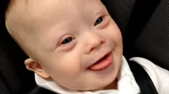 ما أسباب ولادة الطفل المنغولي