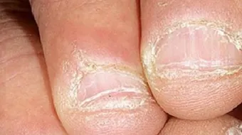 ما هي علامات نقص الحديد