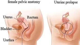 ما هي علامات هبوط الرحم