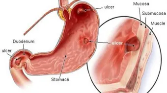 ما هي علامات قرحة المعدة