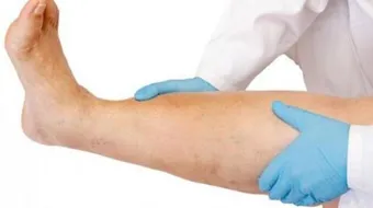 ما هي أعراض الجلطة في الرجل