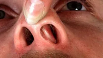 ما هي أعراض اللحمية في الأنف