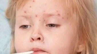 ما هي أعراض مرض الإيدز