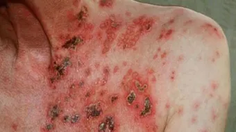 ما أعراض مرض الإيدز