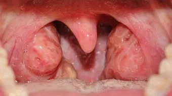 ما هي أعراض اللوز