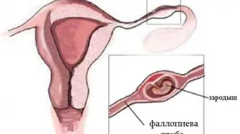 ما هي أعراض وجود كيس على المبيض