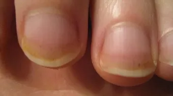 ما هي أعراض الأنيميا