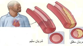 ما أعراض تصلب الشرايين