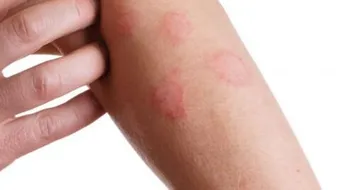 ما هي أعراض مرض بهجت