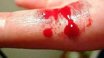 ما هي أعراض سيولة الدم