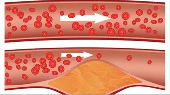 ما هي أعراض تسكير شرايين القلب