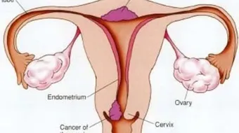 ما هي أعراض التهابات عنق الرحم