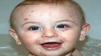 ما هي أعراض جدري الماء