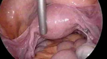 ما هي أعراض الكيس على المبيض