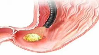 ما هي أعراض التهاب الاثنى عشر