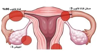ما هي أعراض انسداد قناة فالوب