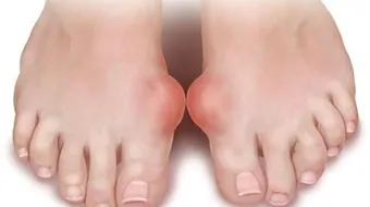 ما هي أعراض داء النقرس