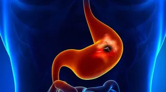 ما هي أعراض حرقة المعدة