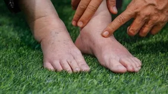 ما هي أعراض ارتفاع نسبة الأملاح في الجسم