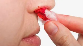 ما هي أعراض النزيف الداخلي في الرأس