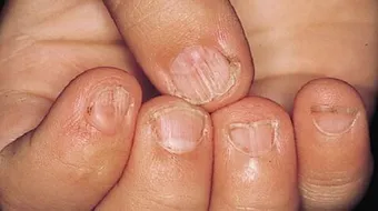 ما هي أعراض نقص الحديد