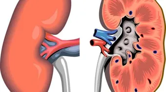 ما هي أعراض الفشل الكلوي