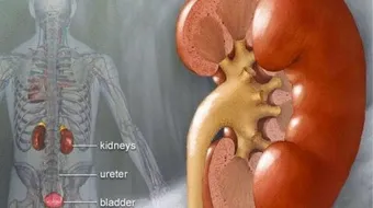 ما هي أعراض حصوة الكلى