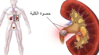 ما هي أعراض حصى الكلى