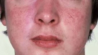 ما هي أعراض نقص صفائح الدم