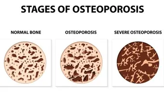 ما هي أعراض هشاشة العظام
