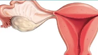 ما هي أعراض سرطان المبيض