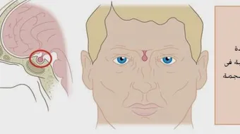 ما هي أعراض ورم الغدة النخامية