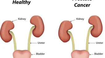 ما هي أعراض احتقان البروستاتا