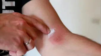 ما هي أعراض الصدفية